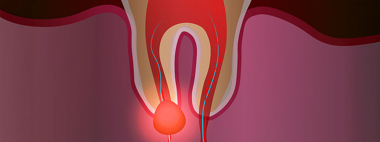 zystenoperation