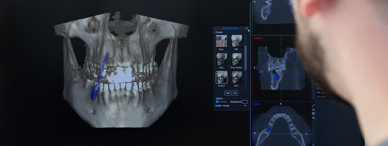 3d-navigierte-implantologie
