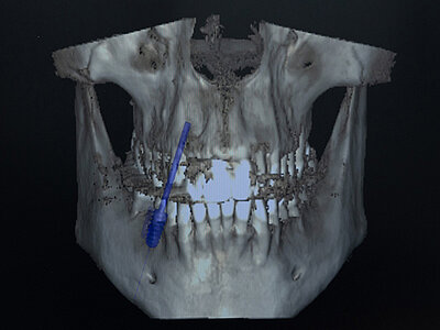 3d-navigierte-implantologie